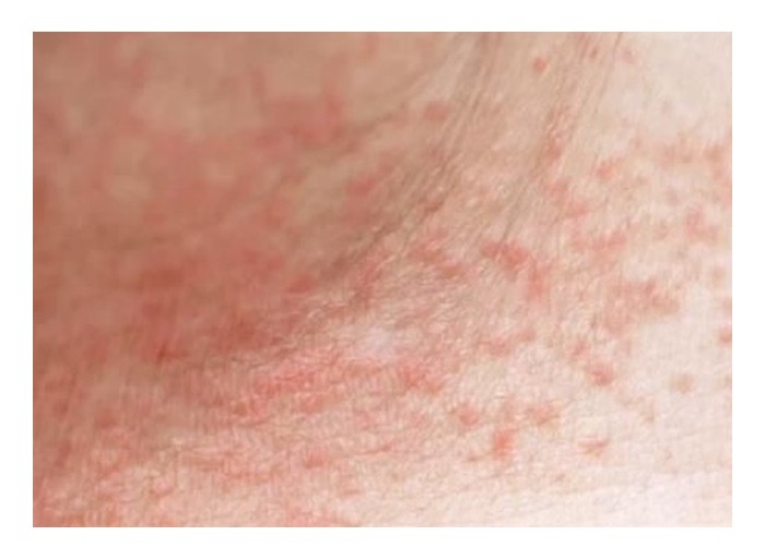 Sudamina: Qué es, Causas, Síntomas y Cómo Aliviarla Rápidamente